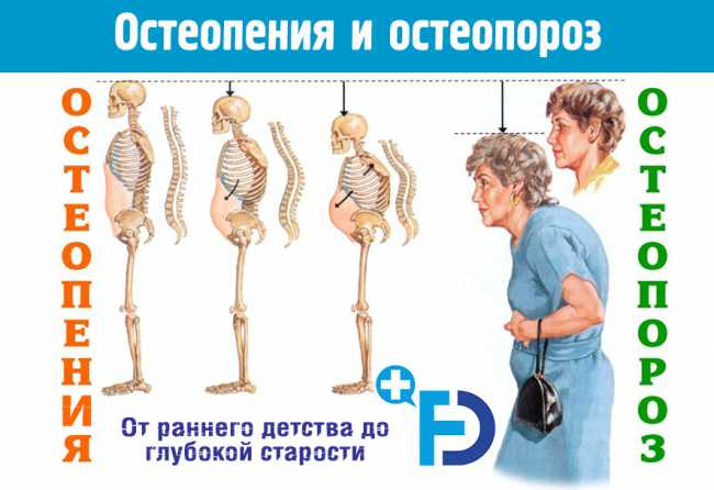 Остеопения и остеопороз: лечение, симптомы, диагностика